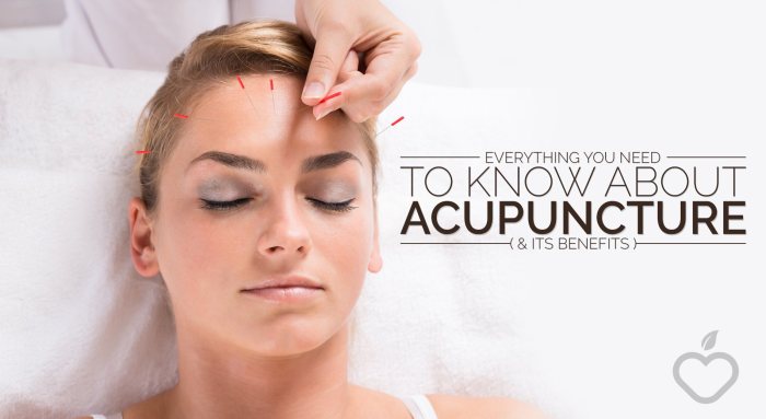 Benefits of acupuncture for holistic wellness